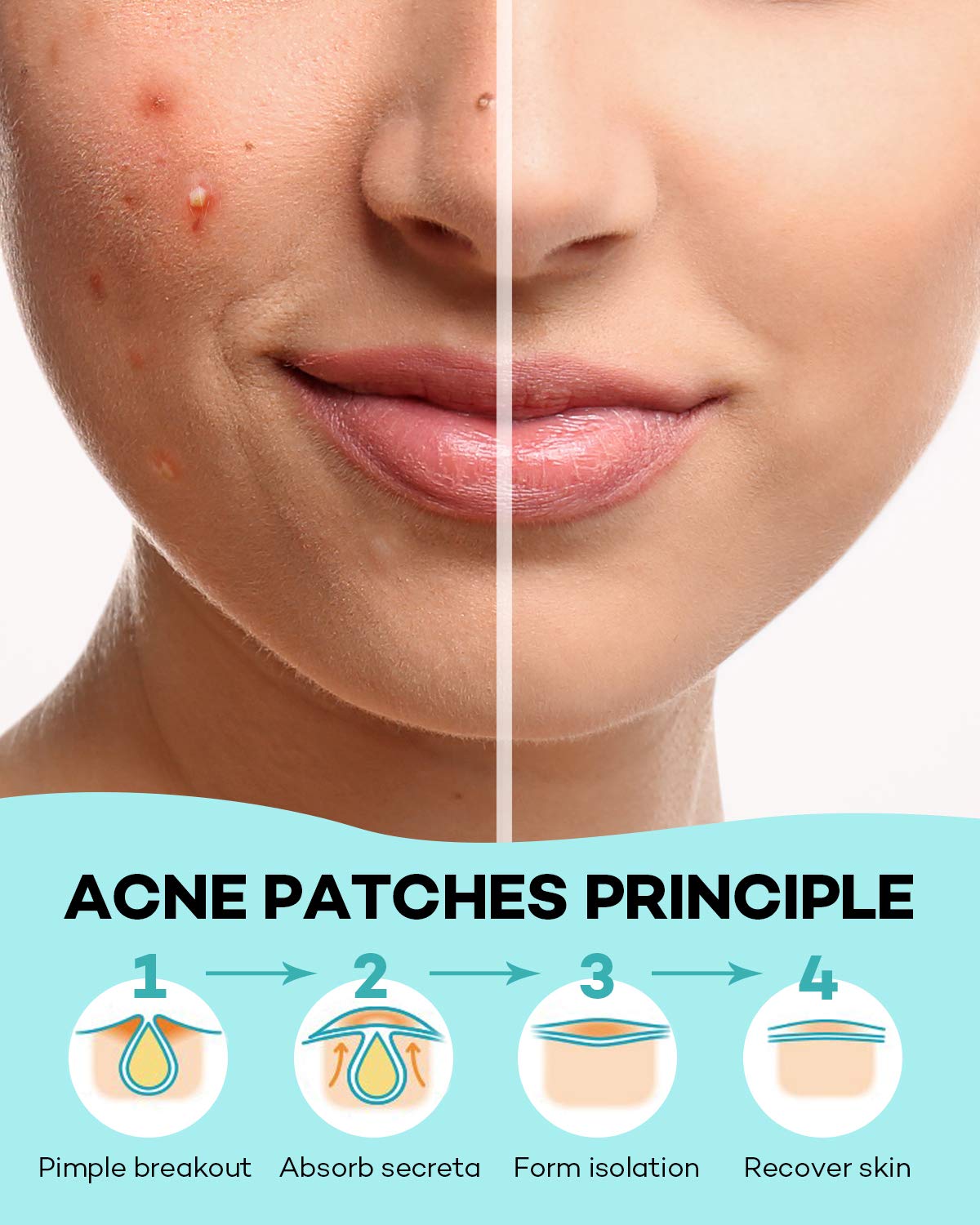 Skin Tag Acne Remover Patch-DriHer